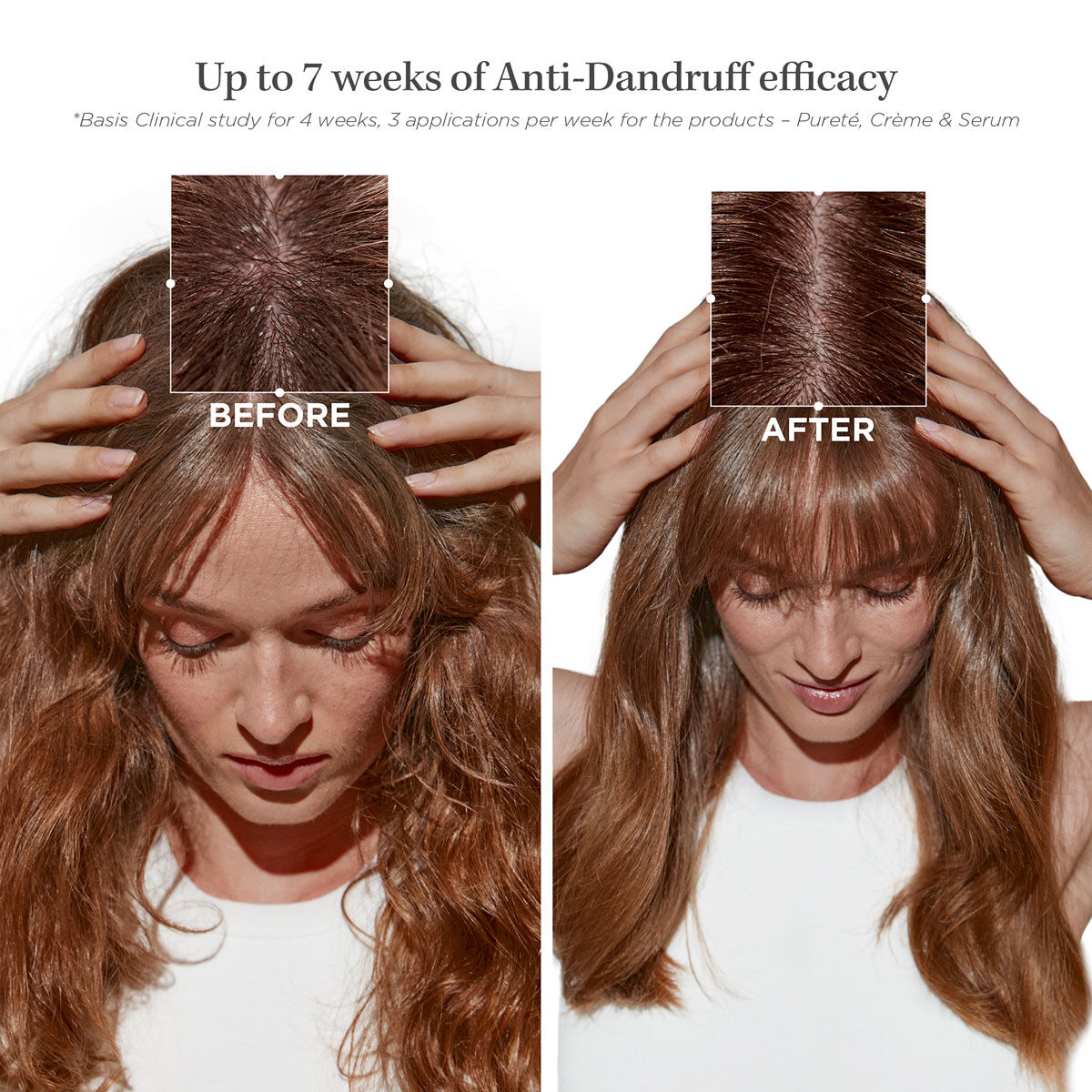 Dandruff with cheap oily scalp